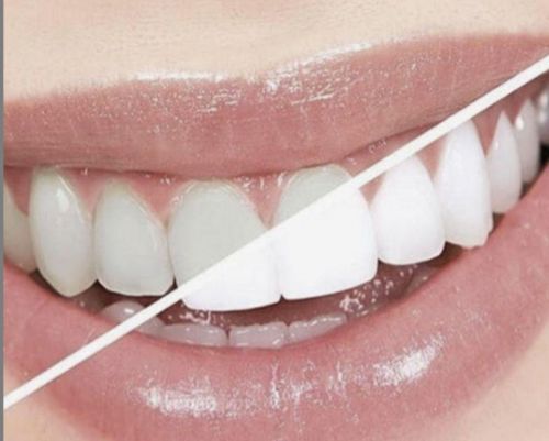 Τα επτά εύκολα βήματα για λευκά δόντια