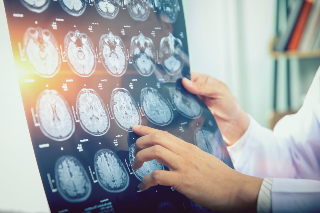 Βρέθηκε ελιξίριο για την υγεία του εγκεφάλου; Τι αποκαλύπτει νέα έρευνα