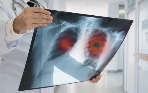Πνεύμονας: Καρκινικά κύτταρα «φωσφορίζουν» με νέα μέθοδο βιοψίας