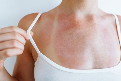 Δέρμα: Πώς αντιμετωπίζουμε τα εξανθήματα από τη ζέστη