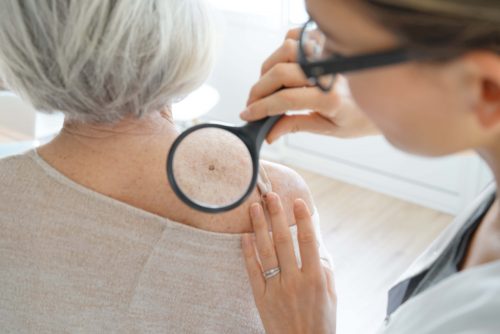 Καρκίνος του δέρματος: Ο αναπόφευκτος παράγοντας που μας αφήνει ευάλωτους