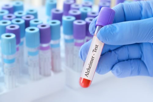 Αλτσχάιμερ: Εγκρίθηκε η πρώτη εξέταση αίματος