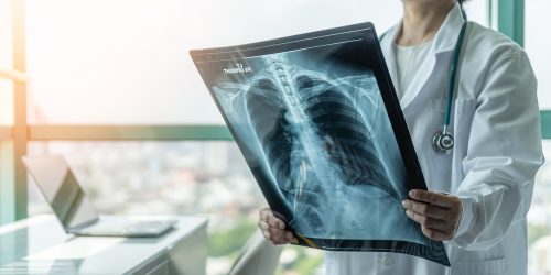 AI: Εντοπίζει όγκους στον πνεύμονα, όσο αυτοί… κινούνται