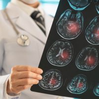 Εγκεφαλικό επεισόδιο: Βλαστοκύτταρα ανέστρεψαν τις βλάβες σε ποντίκια