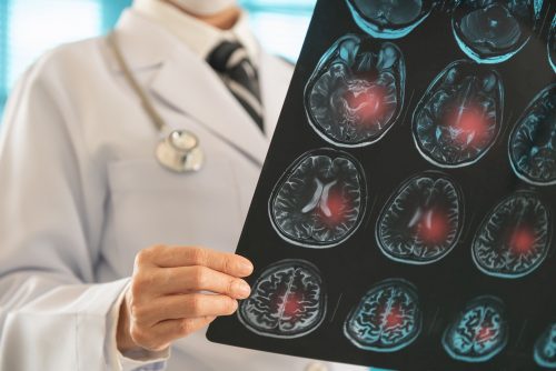 Εγκεφαλικό επεισόδιο: Βλαστοκύτταρα ανέστρεψαν τις βλάβες σε ποντίκια
