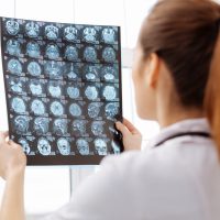 Αλτσχάιμερ και Πάρκινσον: Τι κοινό βρήκαν οι επιστήμονες;