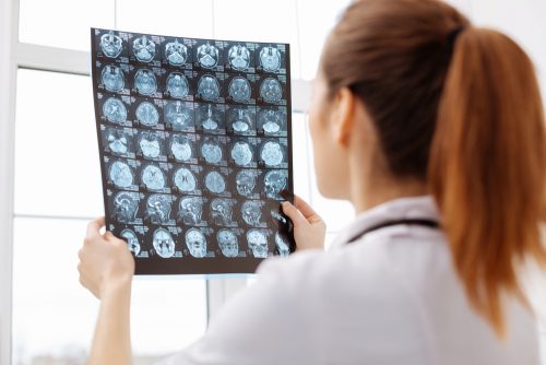 Αλτσχάιμερ και Πάρκινσον: Τι κοινό βρήκαν οι επιστήμονες;