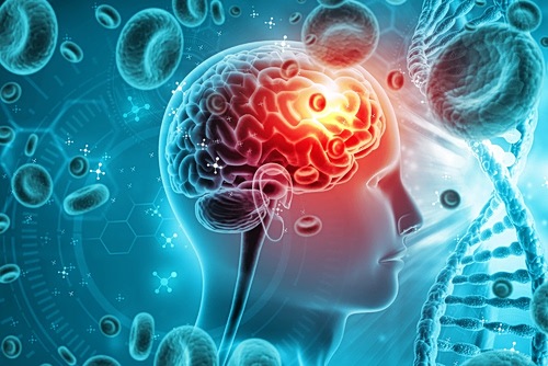 AI: Προβλέπει το Αλτσχάιμερ με 93% ακρίβεια